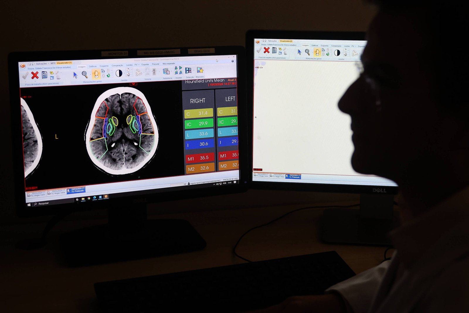 A imagem mostra um profissional de saúde em perfil, observando duas telas de computador. Uma das telas exibe uma imagem de ressonância magnética do cérebro, com áreas destacadas em cores e informações numéricas. A outra tela está em branco. O ambiente parece ser um consultório ou laboratório médico.