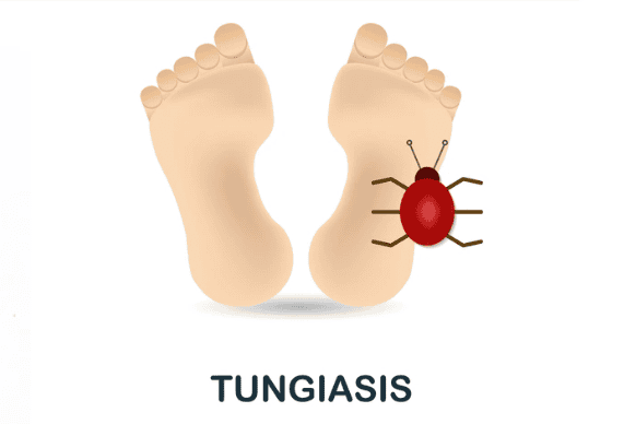 O que é o bicho de pé e como tirá-lo? Entenda a condição de saúde