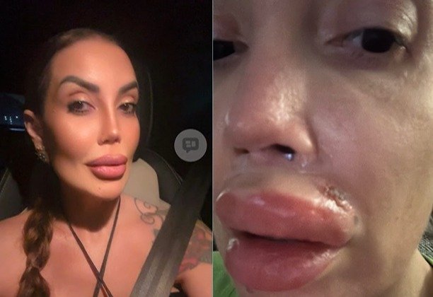 Lábios inchados e dentes quebrados: casos expõem falhas graves em cirurgias estéticas orofaciais