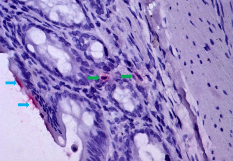 Dano gastrointestinal agrava a febre amarela