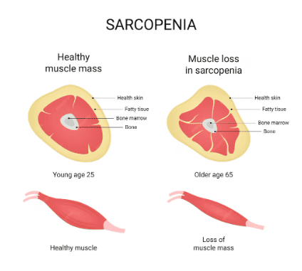O que é Sarcopenia, problema enfrentado por usuários do Ozempic e Mounjaro?