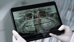 Saliva artificial ajuda a proteger os dentes de pacientes com câncer de cabeça e pescoço