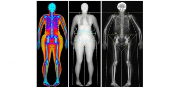 Gordura abdominal está ligada a maior risco de perda urinária em mulheres