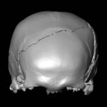 Imagem digital em tons de cinza mostra a parte superior de um crânio humano com fratura irregular na região frontal. O fundo é preto, destacando a superfície lisa e as fissuras do osso.