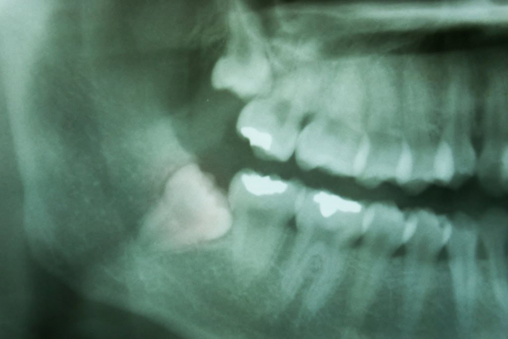 USP desenvolve IA que ajuda dentistas a detectar cáries em radiografias